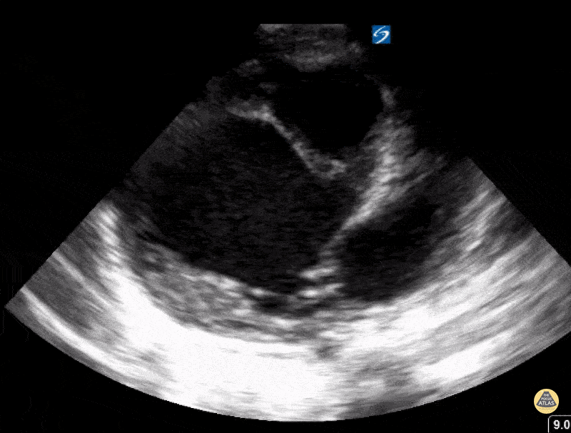 Peds-Cardiac - Familial dilated cardiomyopathy