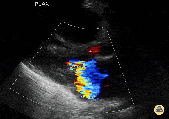 Peds-Cardiac - Multiple valvular abnormalities in a young boy. RV failure.