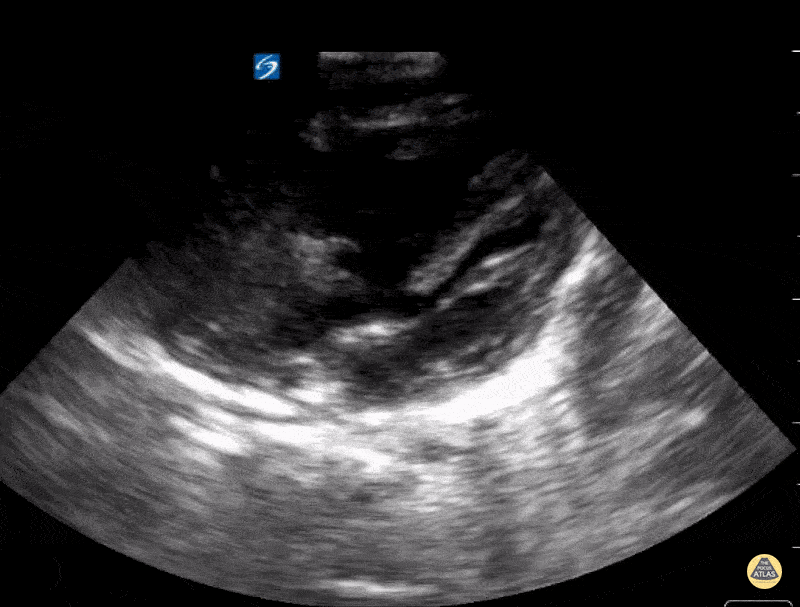 Peds-Cardiac - Tetralogy of Fallot Unrepaired