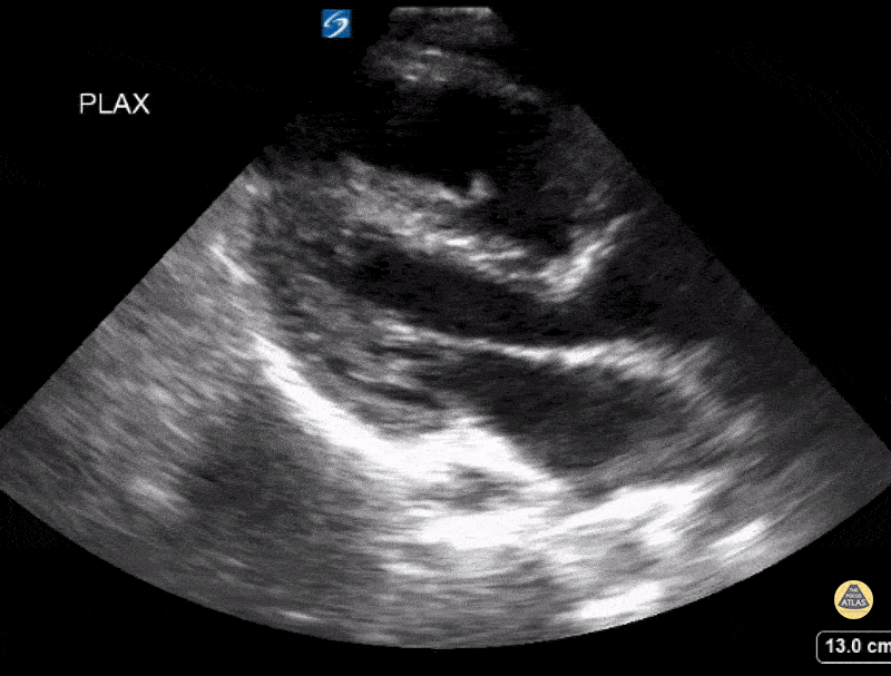 Peds-Cardiac - Tetralogy of Fallot