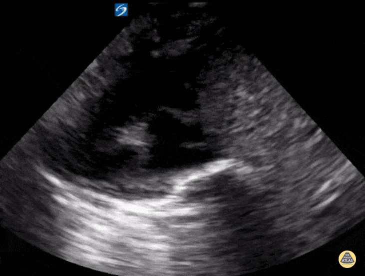 Peds-Cardiac - Tachycardia 4 month old, IVC