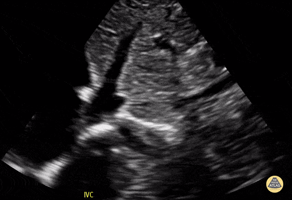 Peds-Cardiac - IVC Normal