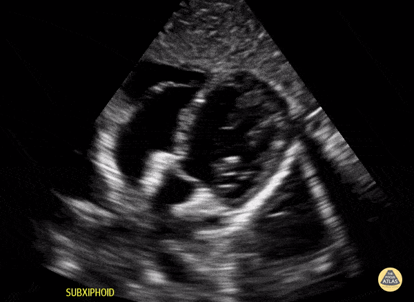Peds-Cardiac - Older Kid Subcostal