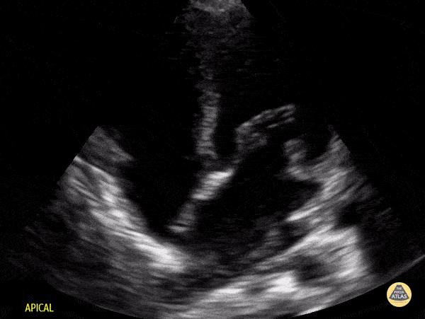 Peds-Cardiac - Older Kid Apical 4 Chamber