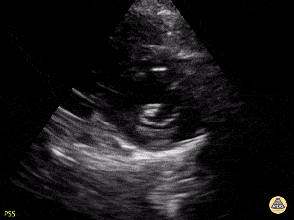 Peds-Cardiac - Older Kid PSSA apex