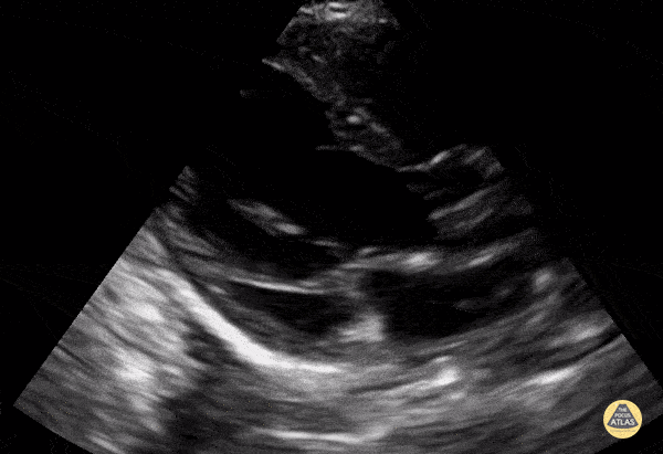 Peds-Cardiac - Older Kid PSLA