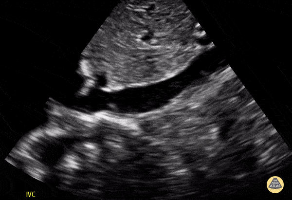 Peds-Cardiac - IVC Normal