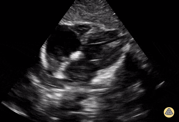 Peds-Cardiac - Older Kid Subcostal