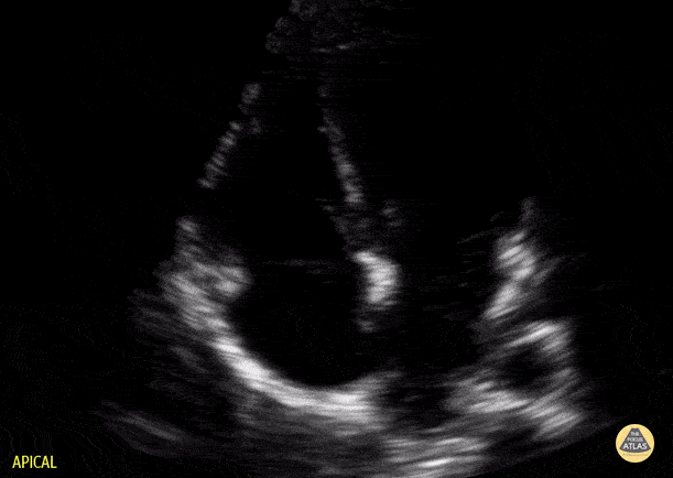 Peds-Cardiac - Older Kid Apical 4 Chamber