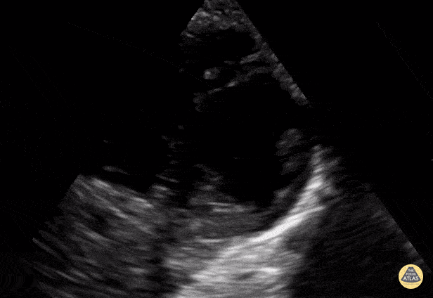 Peds-Cardiac - Older Kid PSSA apex