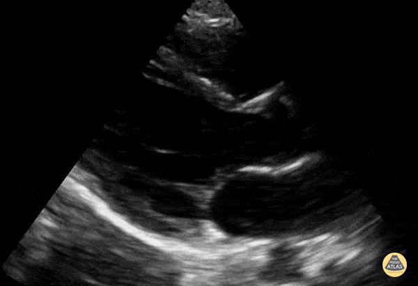 Peds-Cardiac - Older Kid PSLA