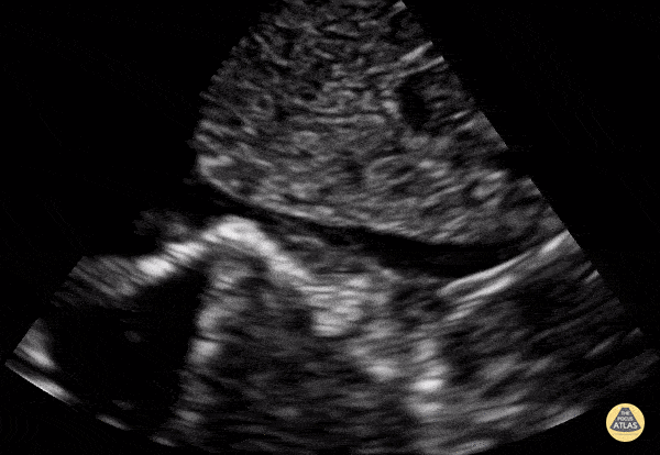 Peds-Cardiac - IVC Normal