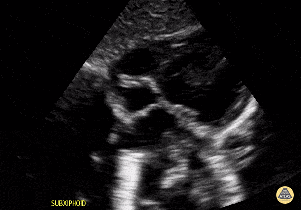 Peds-Cardiac - Toddler Subcostal