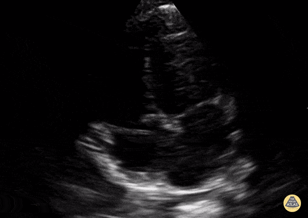 Peds-Cardiac - Toddler Apical 4 Chamber