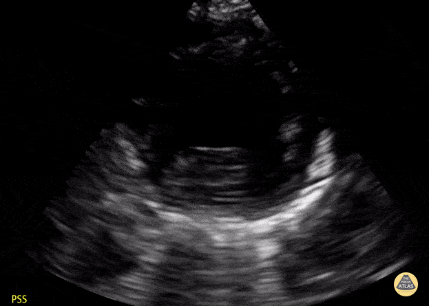 Peds-Cardiac - Toddler PSSA apex