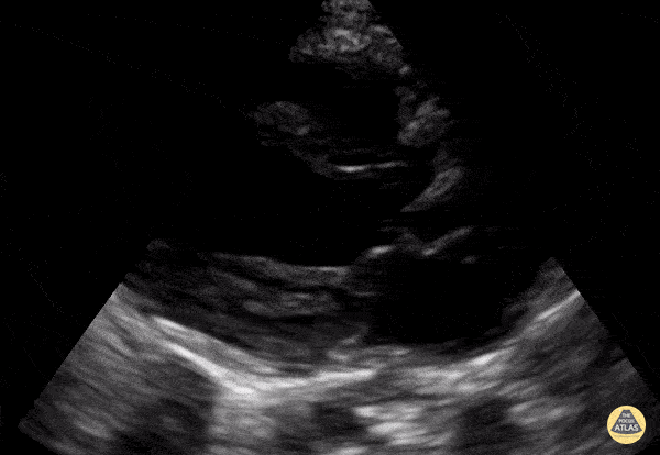 Peds-Cardiac - Toddler PSLA