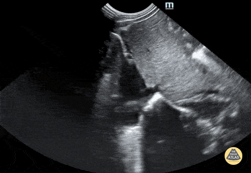 Peds-Cardiac - IVC Normal