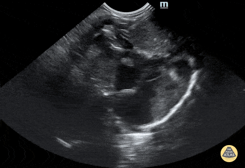 Peds-Cardiac - Neonatal Subcostal