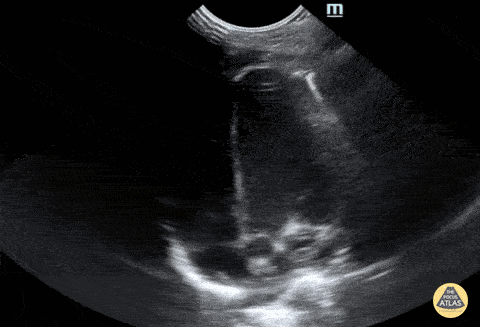 Peds-Cardiac - Neonatal Apical 4 Chamber