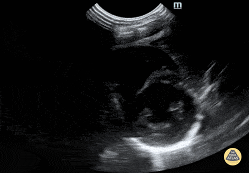 Peds-Cardiac - Neonatal PSSA apex