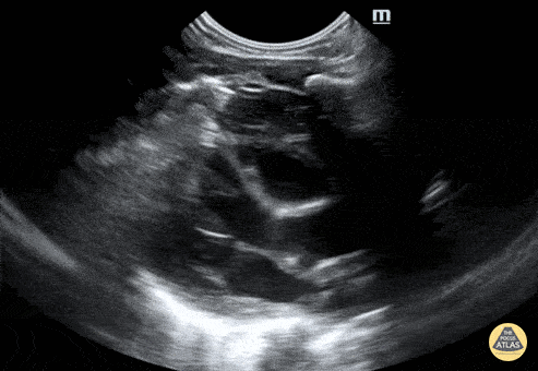 Peds-Cardiac - Neonatal PSLA
