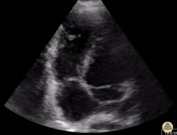 Peds-Cardiac - Truncus Arteriosus S/P Repair