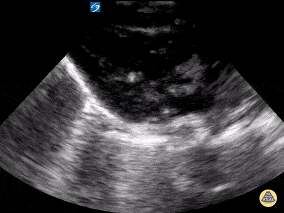 Peds-Cardiac - Cardiac arrest - asystole