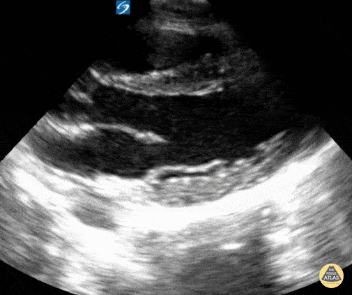Peds-Cardiac - Older kid PSLA