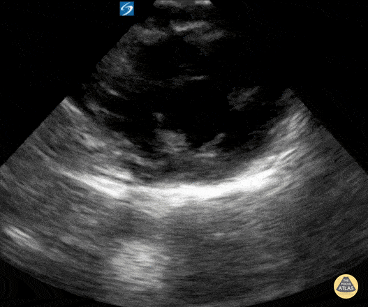 Peds-Cardiac - Older kid PSSA mid