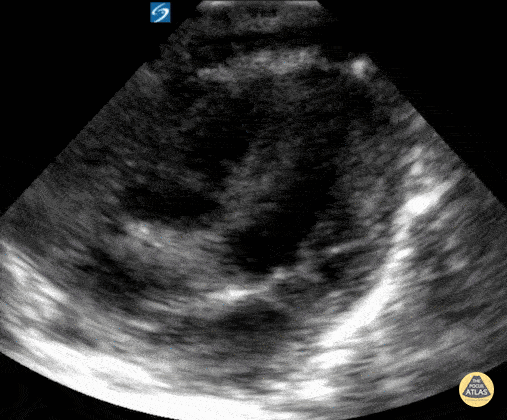 Peds-Cardiac - Normal Neonatal apical 4 chamber view