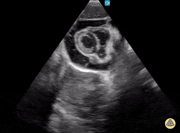 Peds-Cardiac - Pericardial Effusion