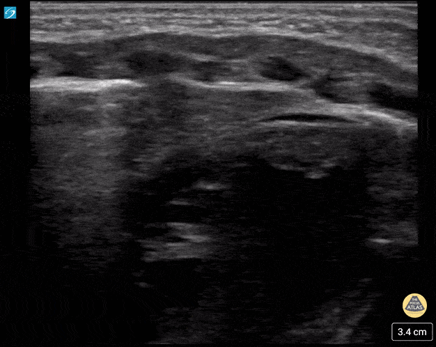 Peds-Cardiac - Thymus