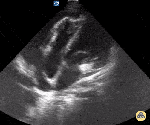 Peds-Cardiac - Pericardial Effusion with Tamponade