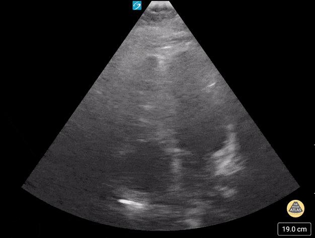 Peds-Cardiac - Ventricular tachycardia