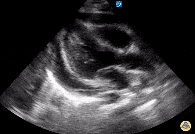 Peds-Cardiac - Moderate fibrinous pericardial effusion