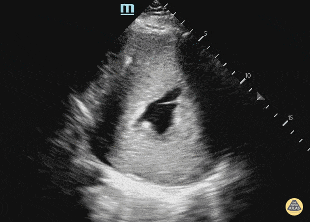Peds-Cardiac - Hypertrophic cardiomyopathy
