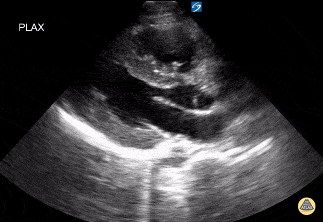 Peds-Cardiac - LVH in pediatric patient