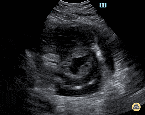 Peds-Cardiac - PSSA with moderate effusion