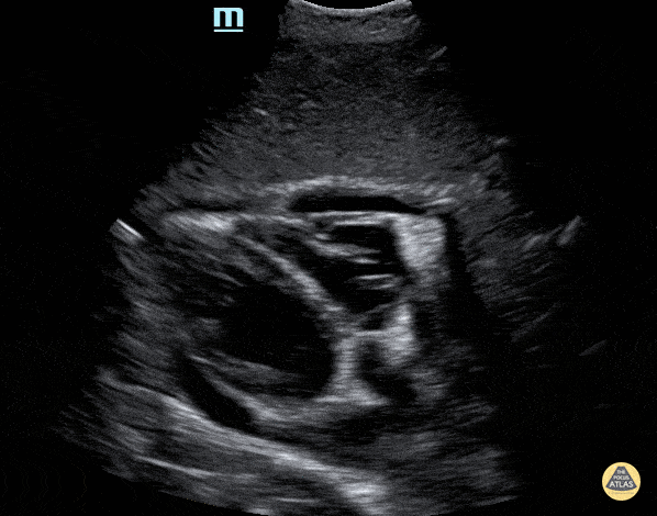 Peds-Cardiac - Small Pericardial Effusion -Subxiphoid