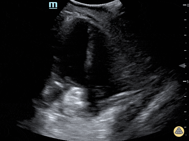 Peds-Cardiac - Apical 4 Chamber showing ASD closed with percutaneous device