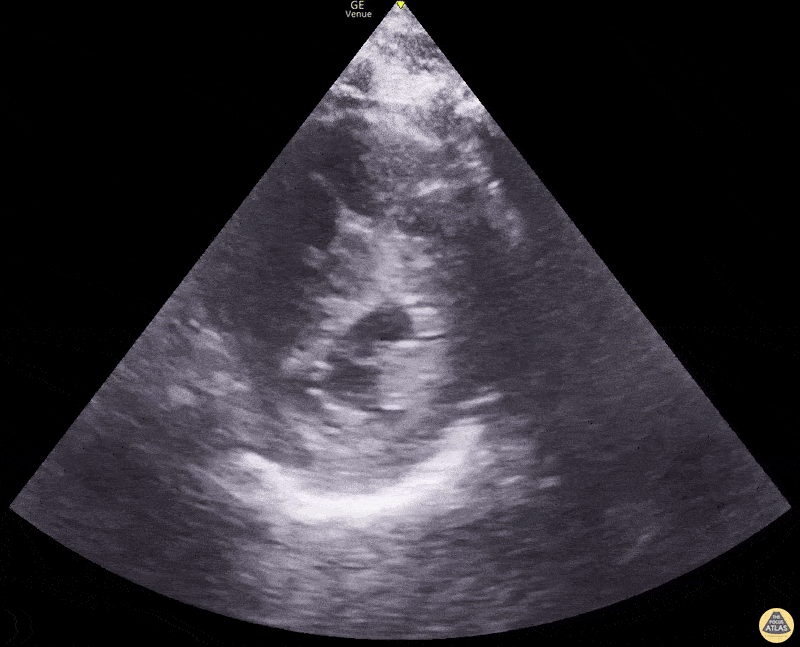 Right Ventricular Dysfunction - D Sign in Right Heart Strain