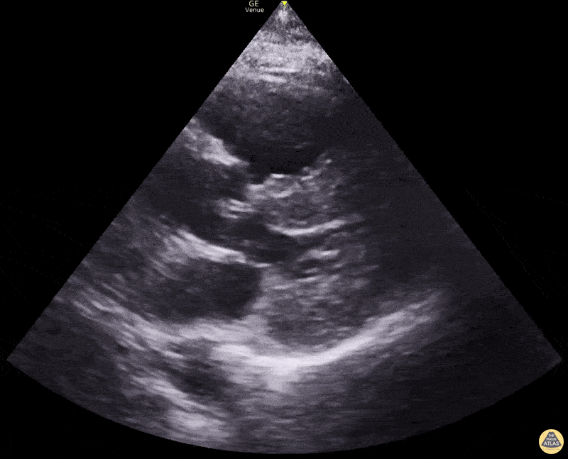 Right Ventricular Dysfunction - Right heart enlargement in PSLA