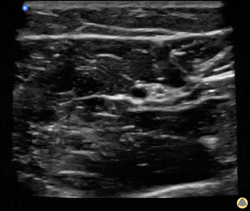Nerve Block Gallery - Ulnar Nerve Block for Boxer's Fracture