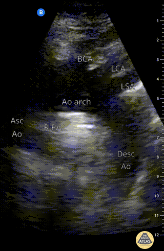 Aorta - Suprasternal view of the aorta with labels