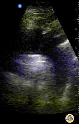 Aorta - Suprasternal view of the aorta