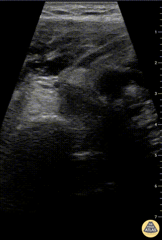 Musculoskeletal - Humeral head fracture with traumatic effusion