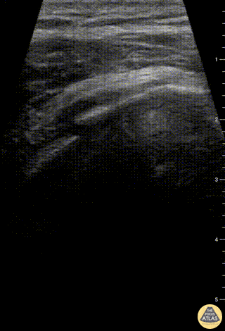 Musculoskeletal - Humeral Head fracture