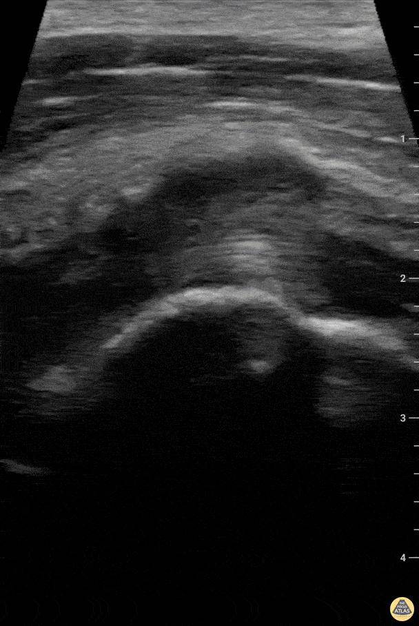 Musculoskeletal - Partial biceps tendon tear - longitudinal