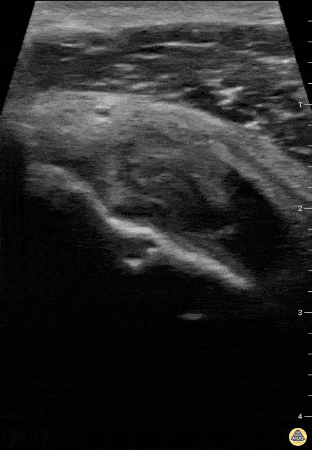 Musculoskeletal - Partial bicep tendon tear Short