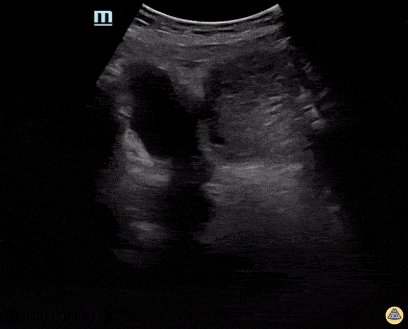 OB/Gyn - Partial Molar Pregnancy Transverse